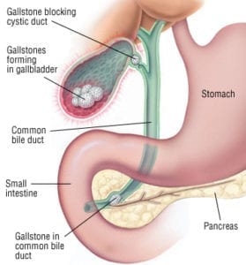 Gallstones