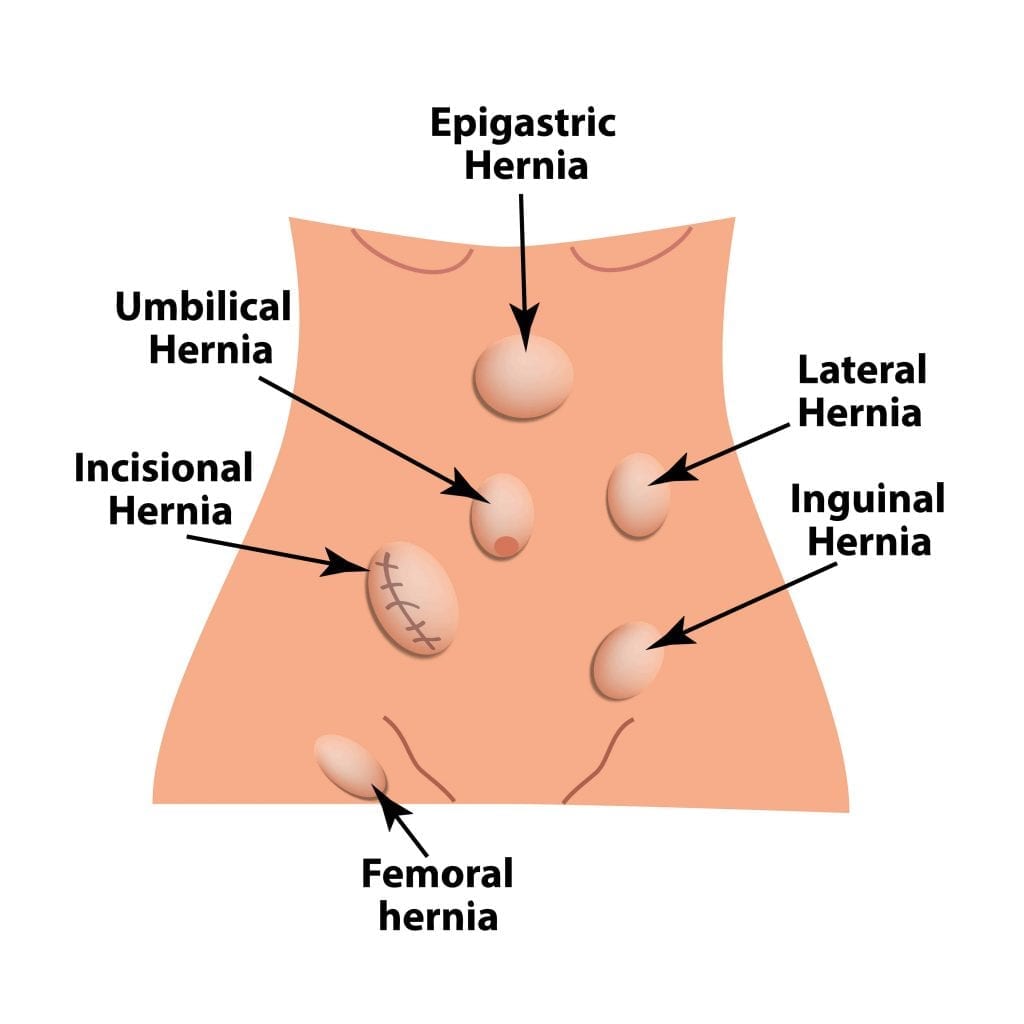 Types of Hernia in Females