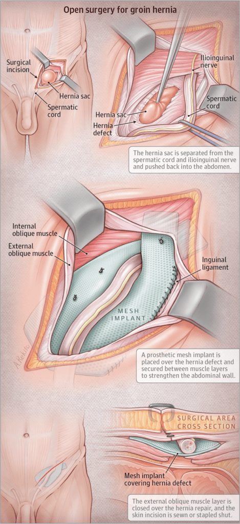 Open Hernia Surgery