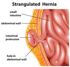Strangulated Inguinal Hernia
