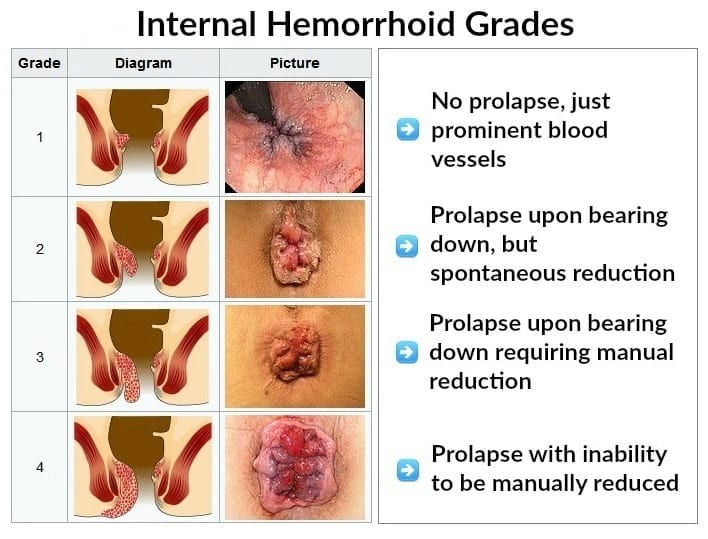 Grades of Hemorrhoids