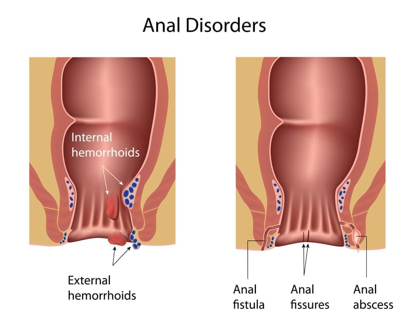 Anal Disorders