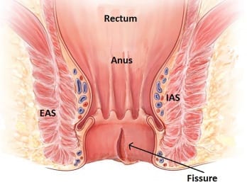 Best Surgeon for Anal Fissure in Abu Dhabi UAE