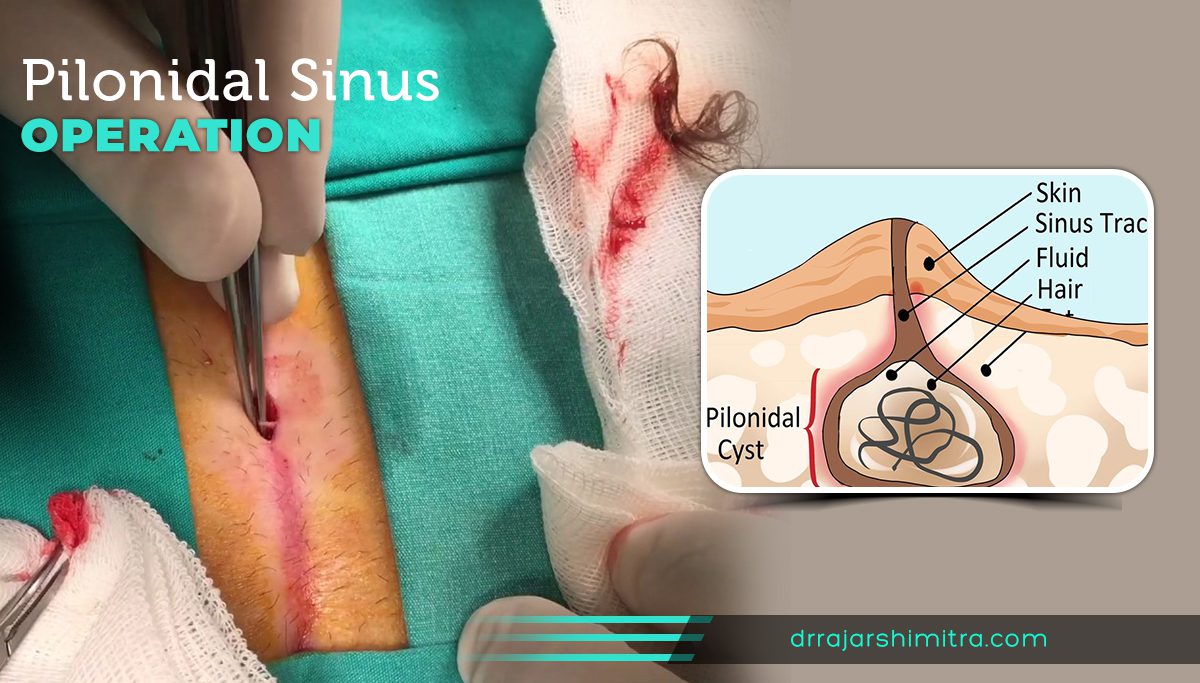 Pilonidal Sinus Treatment Abu Dhabi, UAE