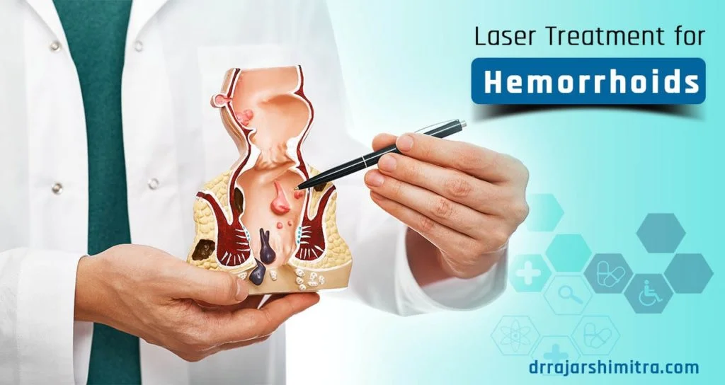 laser treatment for hemorrhoids