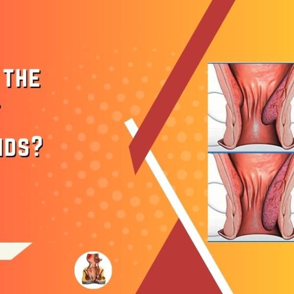 Different Grades of Hemorrhoids.