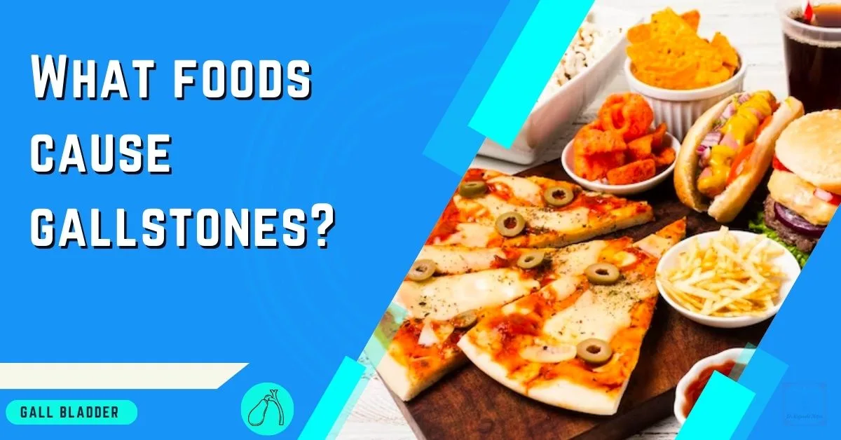An educational graphic asking 'What foods cause gallstones?' in bold, capitalized text on a light blue background. The image on the right displays a variety of high-fat foods such as pizza slices with olives, cheeseburgers, French fries, fried snacks, and sugary sweets, which are often associated with increasing the risk of gallstones. A gallbladder icon and label are also included in the lower left corner, indicating the focus on gallbladder health.