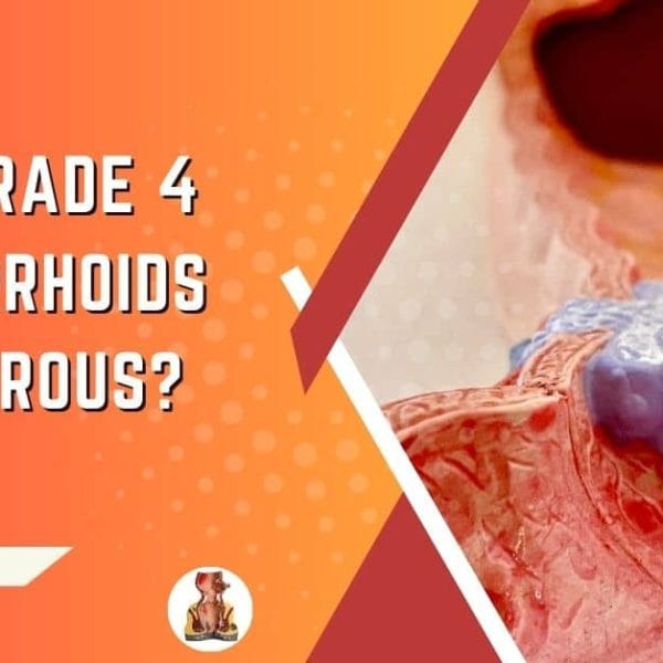 Are Grade 4 Hemorrhoids Cancerous? Detailed answer.