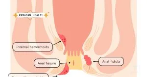 Causes of Anal Fissures During Ramadan