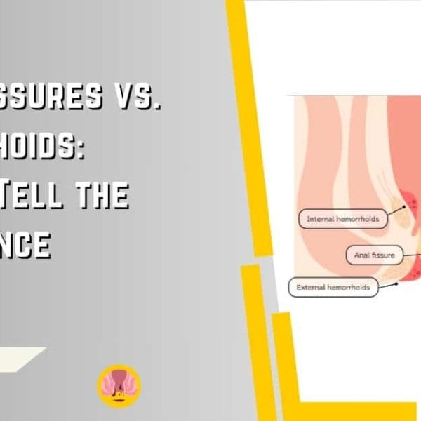 Anal Fissures vs. Hemorrhoids How to Tell the Difference